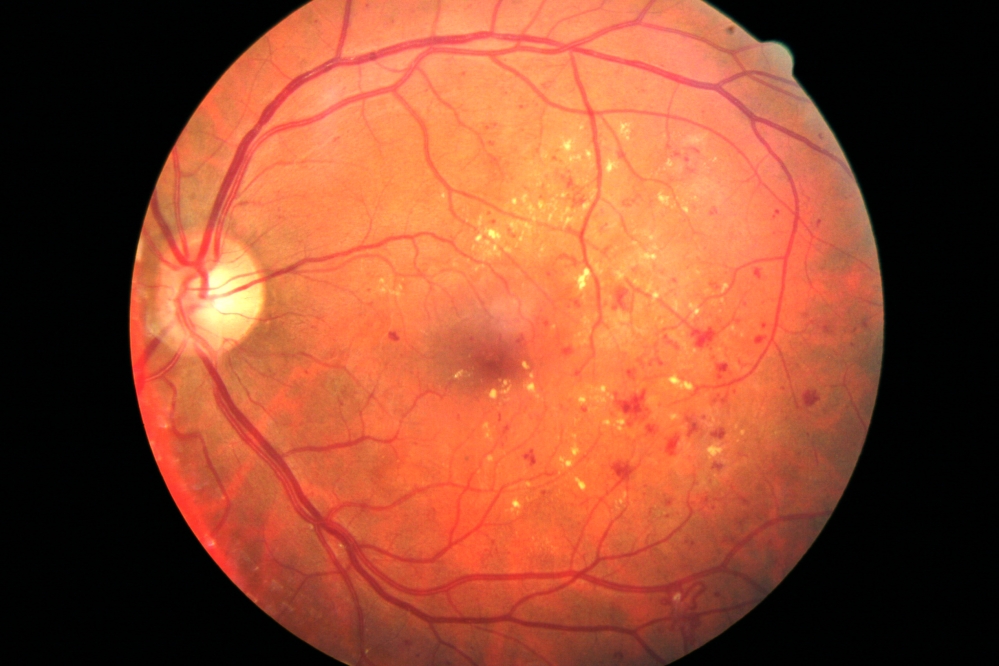 diabetic_retina