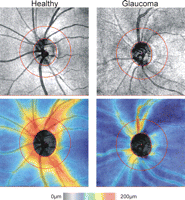 optic nerve